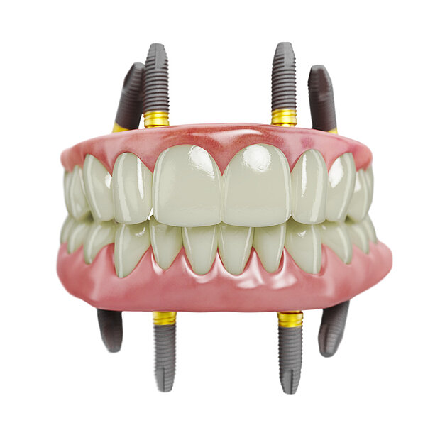All-on-4®-Konzept: Versorgung des zahnlosen Ober- und Unterkiefers mit einer Brücke, die von jeweils 4 Implantaten getragen wird.