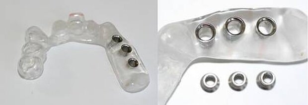  Oberkiefer-Bohrschablone für 3 Implantate