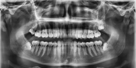  
Oralchirurgie: Operationen an Zähnen und Kiefer - Extraktionen von verlagerten Weisheitszähnen.
Bildquelle: ©GZFA
 