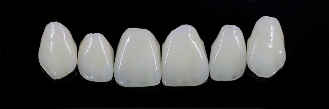 Ein Bild von natürlichen funktionellen Keramik-Veneers aus Presskeramik, die hochästhetische, langlebige Verblendschalen sind