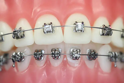 Ein Bild von einem Mund mit Metallbrackets von der Kieferorthopädie Dr. Moritz Hillmann