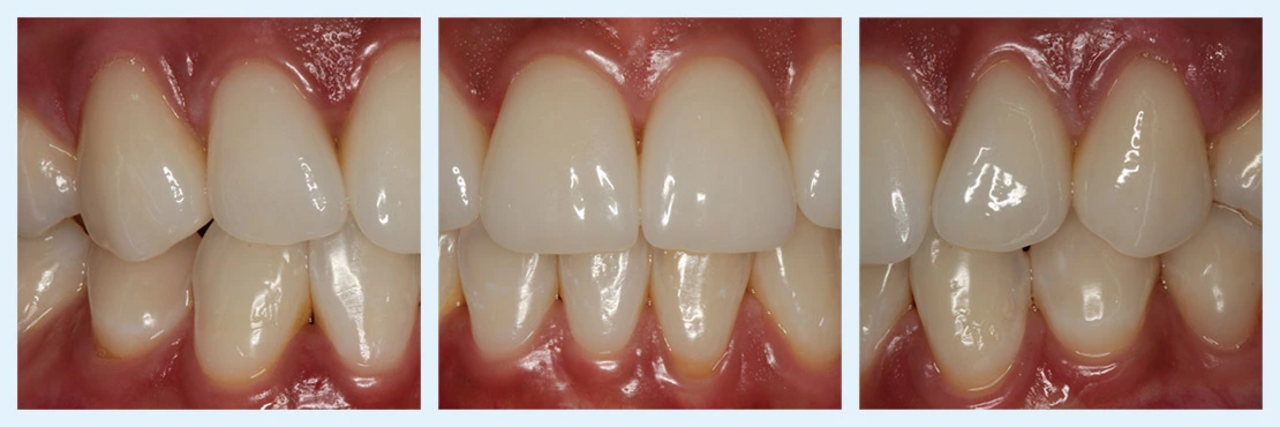 Ein dreiteiliges Bild von natürlicher funktioneller Frontzahn-Ästhetik aus Vollkeramik von Weiß Dentaltechnik