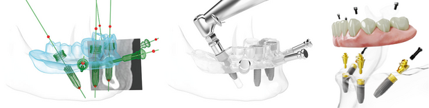 All-on-4®-Konzept im Unterkiefer: 3D- Planung und Einsetzen der 4 Implantate mittels Bohrschablone.  Dabei werden die beiden äußeren Zahnimplantate schräg, die beiden inneren gerade im Kieferknochen verankert.
