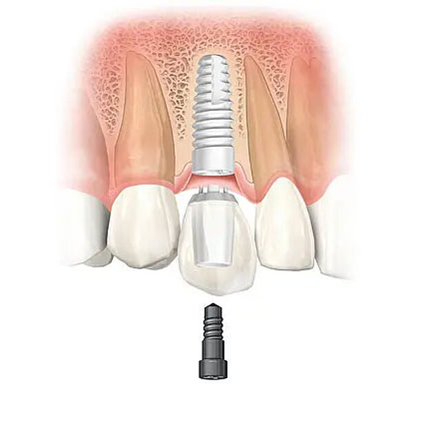 Behandlung mit Zahnimplantaten: Wie werden Zahnlücken mit Implantaten behandelt? Behandlung mit Zahnimplantaten: Wie werden Zahnlücken mit Implantaten behandelt?