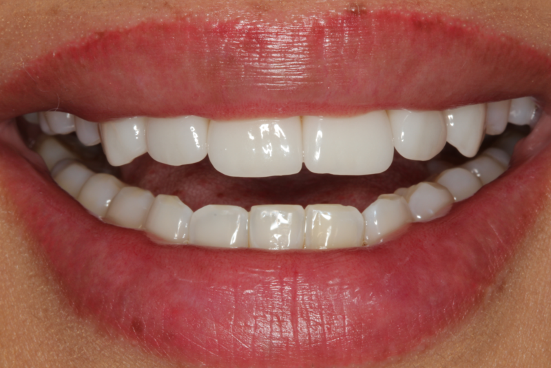 Das Bild zeigt den Mund einer Patientin mit Keramik-Veneers