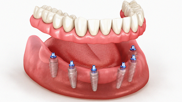 ZMK Implantate