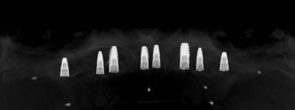 8 Implantate im zahnlosen Oberkiefer für festsitzenden Zahnersatz
