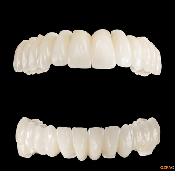 Zahnloser Patient:KFR - Komplette funktionelle und ästhetische Rekonstruktion aus Zirkon-Vollkeramik für den Ober- und Unterkiefer auf 6 und 8 Implantaten.