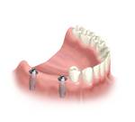 Versorgung der verkürzten Zahnreihe mit zwei Implantaten