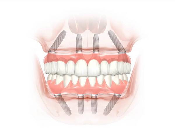 All-on-4®-Konzept: Versorgung des zahnlosen Ober- und Unterkiefers mit einer Brücke, die von jeweils 4 Implantaten getragen wird.