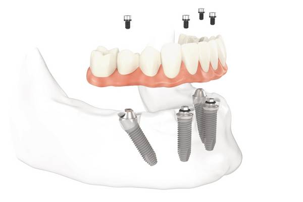 Das Original: All-on-4™-Konzept für zahnlose Patienten. Ablauf, Kosten und Möglichkeiten von Ihrem All-on-4™-Spezialisten.