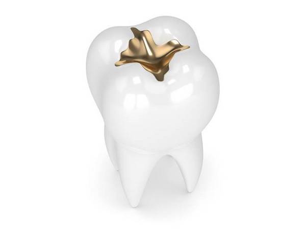 Gold-Inlay: Mehrflächig