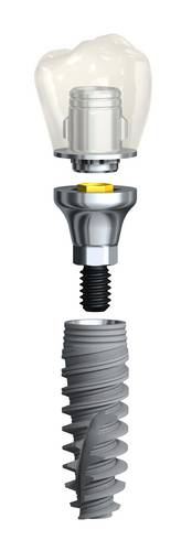 Zahnimplantat aus Titan, Implantat-Abutment (Verbindungselement) und Zahnkrone.