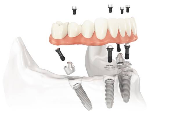 Okklusale Rehabilitation des zahnlosen Unterkiefers mit dem All-on-4™-Behandlungskonzept.