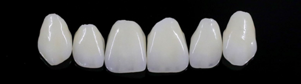 Veneers im Oberkiefer: Hauchdünne Verblendschalen aus Keramik für die perfekte Frontzahnästhetik.