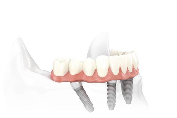 Versorgung eines zahnlosen Unterkiefers mit Zahnersatz auf 4 Implantaten