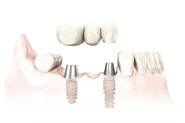 Zirkonkeramikbrücke auf zwei Implantaten