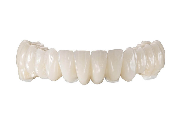 Zahnersatz: Zirkonkeramikbrücke im Unterkiefer auf 6 Implantaten Zahnersatz: Zirkonkeramikbrücke im Unterkiefer auf 6 Implantaten