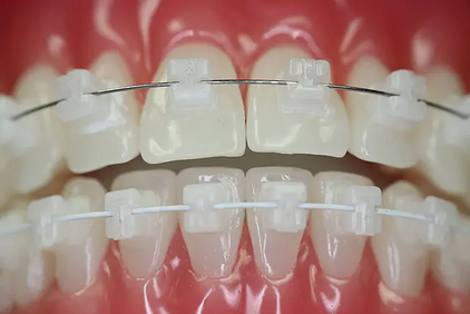 Ein Bild von einem Mund mit Keramikbrackets von der Kieferorthopädie Dr. Moritz Hillmann