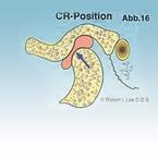 Abb. 16 zeigt eine stabile Kiefergelenkposition (CR = Centric Relation)