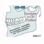 Abb.17 zeigt die optimale Position für Zähne und Kiefergelenk: die Zahnkontakte sind harmonisch in maximalem Vielpunktkontakt, die Position der Kiefergelenke stabil.