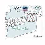 Abb.18 zeigt einen Vorkontakt im Seitenzahnbereich, der keine harmonische Okklusion (CO-Position) zulässt.
