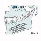 Abb.19 = der Unterkiefer nimmt die scheinbar bestmögliche Position ein, indem er sich verlagert (=habituelle Okklusion): keine stabile Kiefergelenkposition (CR-Position) mehr möglich.