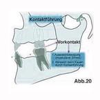 Abb.20 = Kontaktführung - Verschieben der Zähne bzw. Kiefer in eine habituelle Okklusion, ausgelöst durch Vorkontakte.