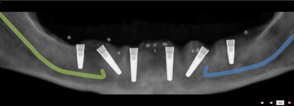 6 Implantate im Unterkiefer für festsitzenden Zahnersatz