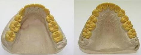 Wax-up im Unterkiefer (links) und im Oberkiefer (rechts) Die Kauflächen werden mittels Modellierwachs funktionell und ästhetisch neu gestaltet.