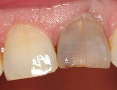 Wird grau zahn wurzelbehandelter Wurzelbehandelter Zahn,