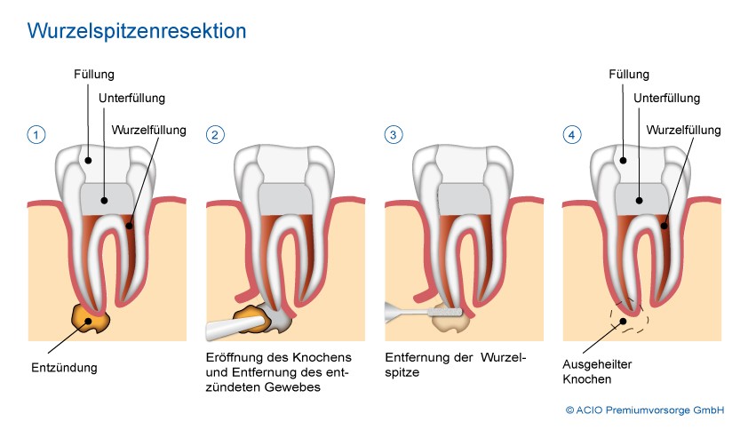 Zahnherde-Störfelder Sprechstunde: Risiken erkennen.