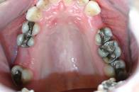 Wann sollte eine Zahnfüllung aus Amalgam ausgetauscht werden?