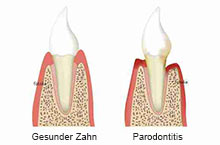 Zahnfleisch- und Parodontosebehandlung